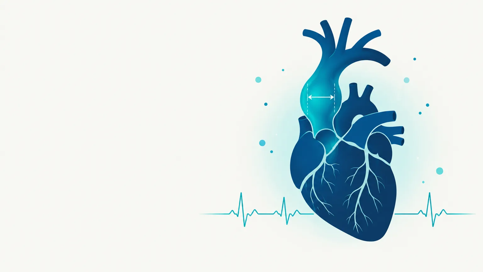 Ilustração Aneurisma de Aorta